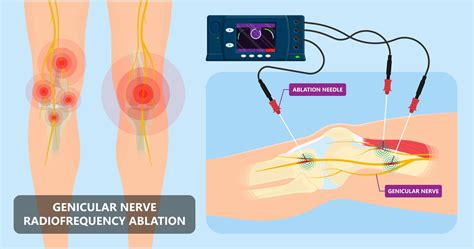 Nerve blocks show efficacy in knee osteoarthritis - Medical Update Online