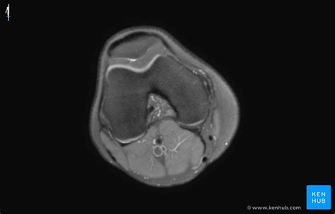 How to read the normal knee MRI | Kenhub