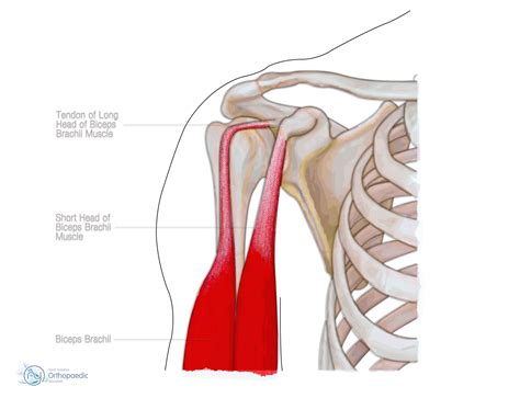 Biceps Tendon Rupture | Orthopaedic - Hywel Williams