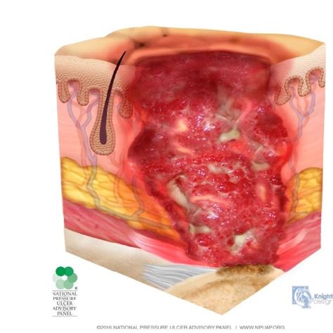 (PDF) Conceito e classificação de lesão por pressão: atualização do National Pressure Ulcer ...