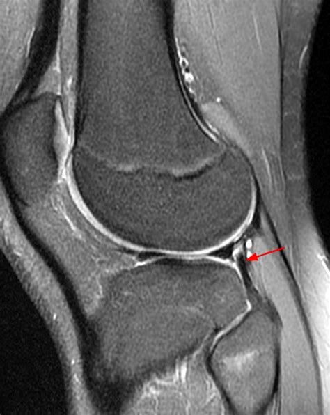 Popliteus Tendon Mri