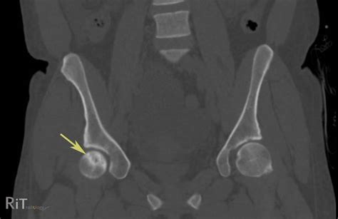 RiT radiology: Avascular Necrosis of the Hip