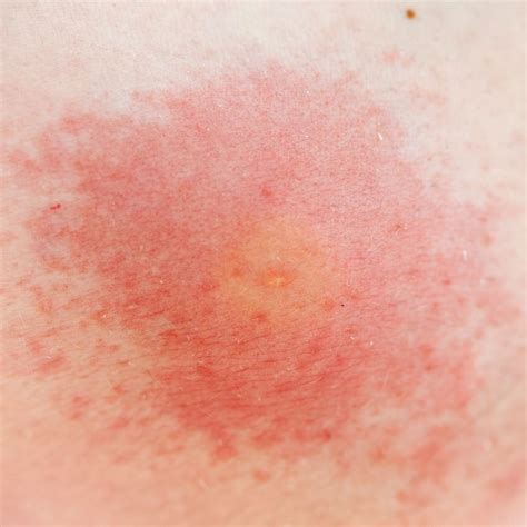 Pictures of Common Bug Bites and Stings, Plus Symptoms to Look For