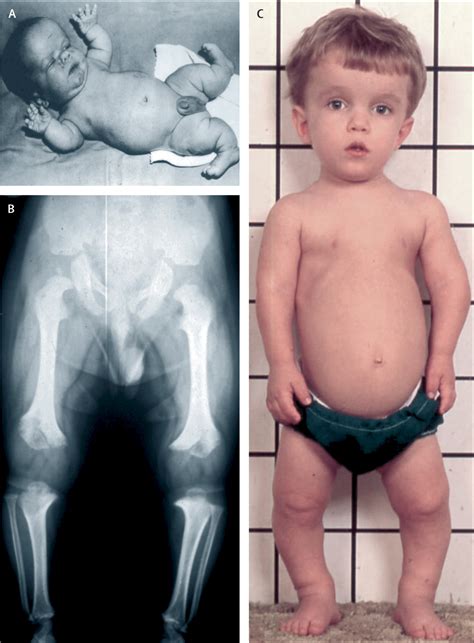 Dwarfism Types Achondroplasia