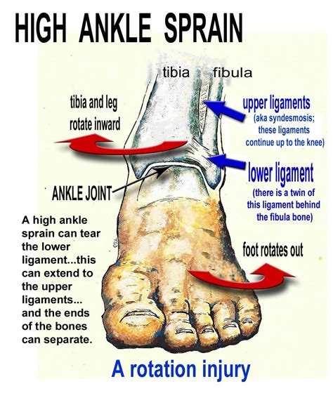 High Ankle Sprain