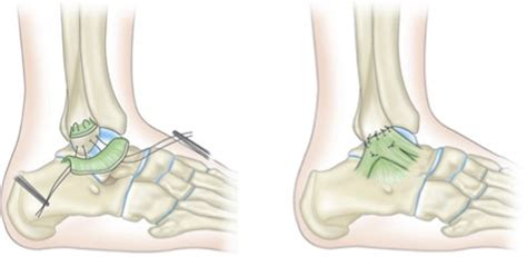 COSM | Lateral ligament reconstruction