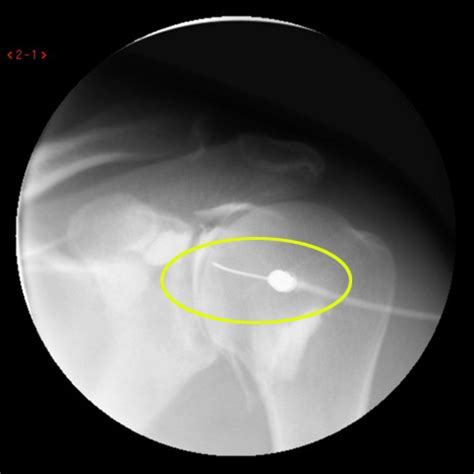 MRI Arthrogram Shoulder: Rule Out Labral Tear | Cedars-Sinai