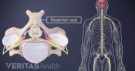 Nerve Root Definition | Back Pain and Neck Pain Medical Glossary