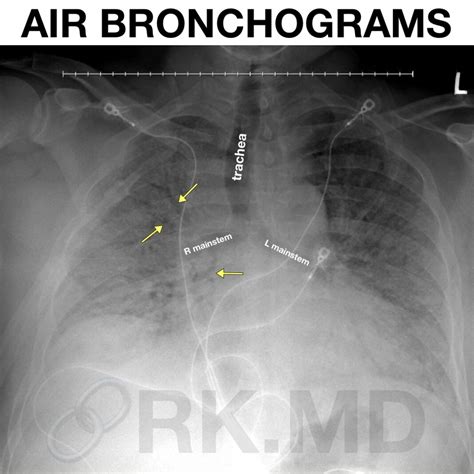 Air Bronchograms | RK.MD