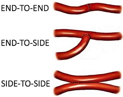 Anastomosis surgery, vascular anastomosis and bowel anastomosis