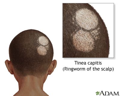 Tinea capitis Information | Mount Sinai - New York