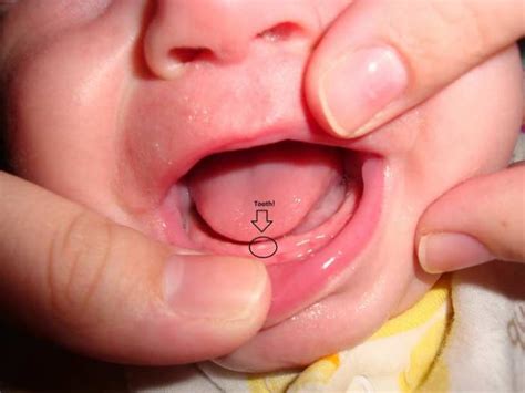 White Spots on Gums- Baby, Painful, Pictures, Above, Below Teeth, Hard, Causes & How to Get Rid