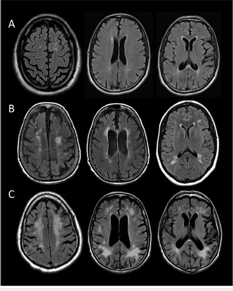 Grading of leukoaraiosis severity based on the Fazekas scale. (A ...