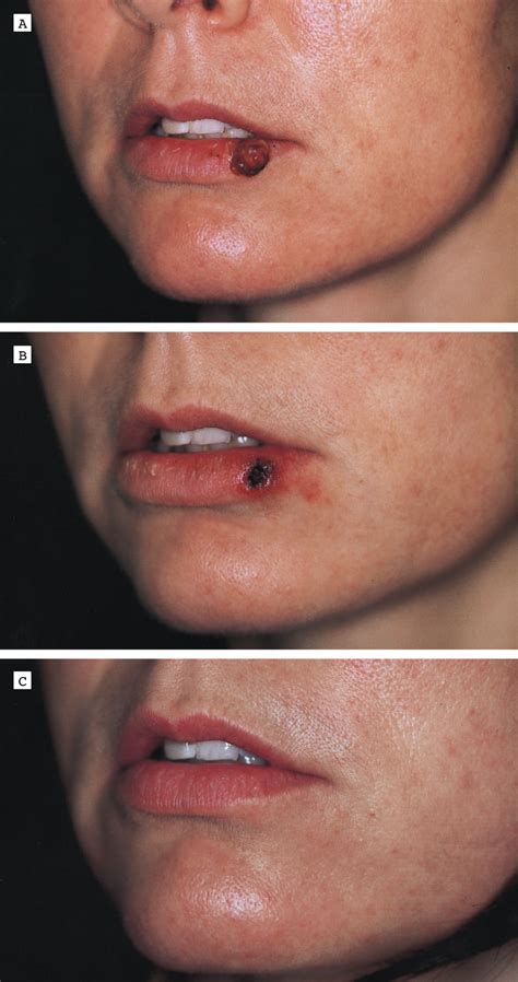 The Combined Continuous-Wave/Pulsed Carbon Dioxide Laser for Treatment ...