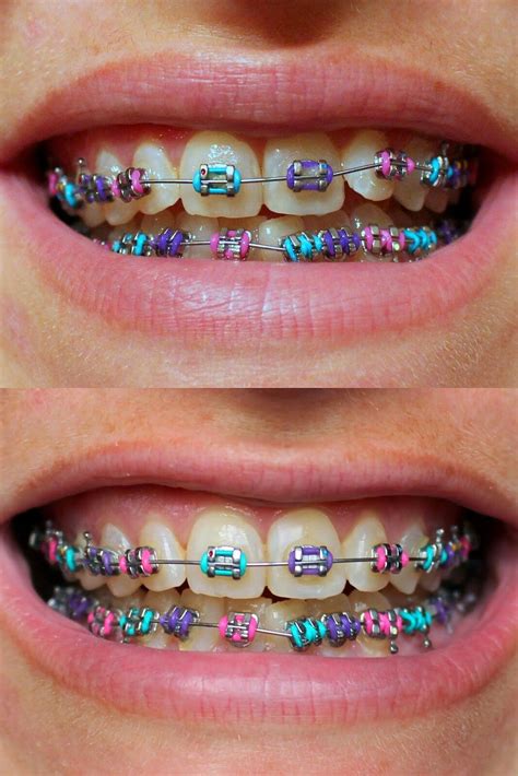 Pin de Althea Barbesino en Potpourrì | Brackets dentales, Dientes con ...