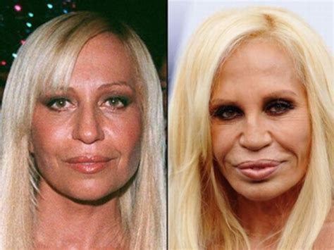 29 Hollywood Celebrities Who Have Spent Thousands On Cosmetic Surgery ...