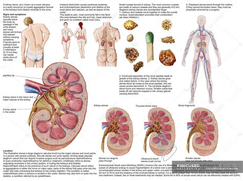 Medical chart with the signs and symptoms of kidney stones — renal pelvis, anatomy - Stock Photo ...