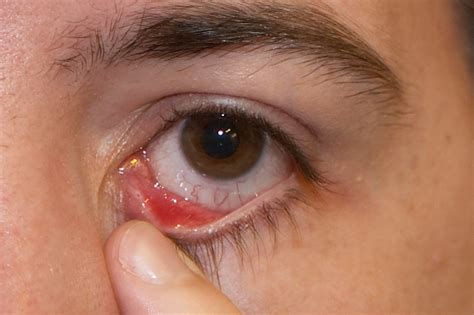 Eye Stye - Causes, Symptoms, Treatment, Pictures | Stye Eye | Stye in ...