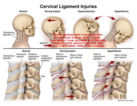 AMICUS Illustration of amicus,injury,cervical,ligament,injuries,whiplash,interspinous,impact ...