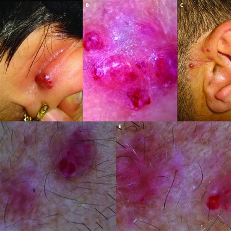 Clinical and dermoscopic pictures of angiolymphoid hyperplasia with... | Download Scientific Diagram