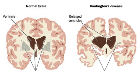 Huntington's Disease: Symptoms, Stages & 5 Natural Treatments ...