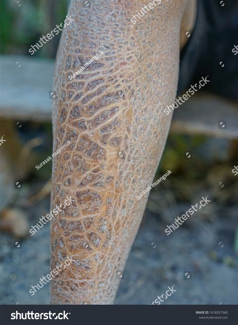 Dry Skin Causes Skin Diseases Winter Stock Photo 1618357360 | Shutterstock