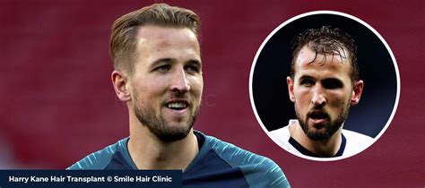 Harry Kane Hair Transplant - Smile Hair Clinic