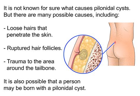 PatEdu.com : Pilonidal Cyst