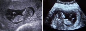 11 week pregnant ultrasound | Pregnancy Health