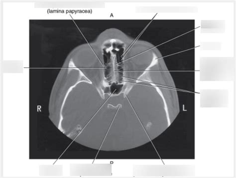 Axial CT of Ethmoid Bone Diagram | Quizlet