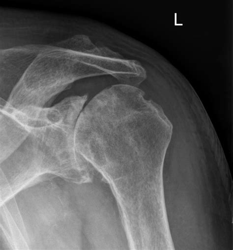 Osteoarthritis X Ray Shoulder