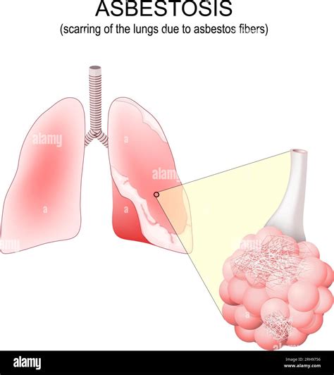 Asbestosis. scarring lungs. Human lungs with plaque that caused by ...