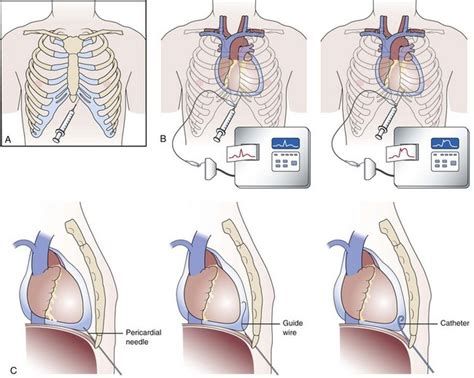 Pericardial Window Procedure Steps