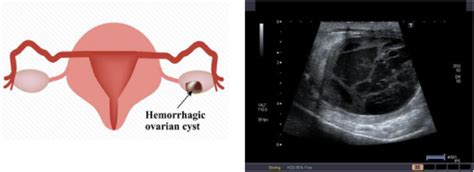 Hemorrhagic ovarian cyst (HOC) | Download Scientific Diagram