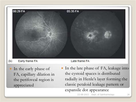 Cystoid macular oedema