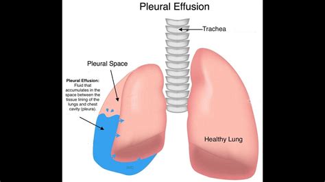 Pleural Effusion (Anatomy Clinical) - YouTube