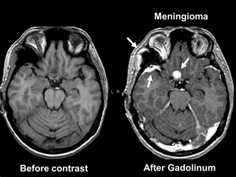 Head Mri With Contrast