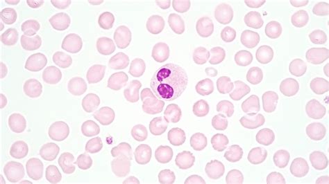 Hyposegmented Neutrophils