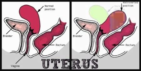 Retroverted Uterus (Tilted Uterus): Cause, Symptoms, Treatment