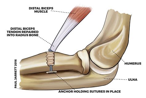 Distal Biceps Tendon Rupture / Avulsion | Murdoch Orthopaedic Clinic