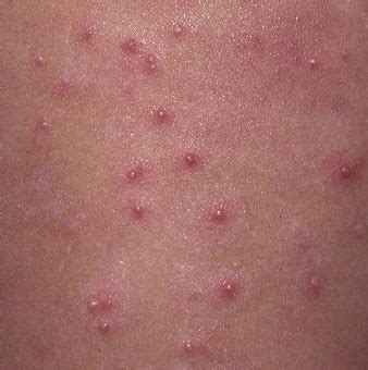 Eczema Bumps On Arms