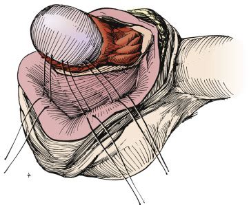 Reduction of Testicular Torsion | Abdominal Key