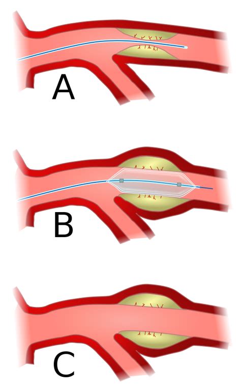 Angioplasty - Wikiwand