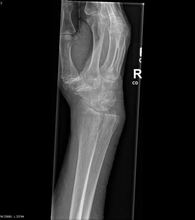 Distal radial fracture, triscaphe and first carpometacarpal joint osteoarthritis | Image ...