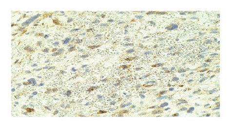 Beta-catenin showing predominantly a cytoplasmic pattern of staining in... | Download Scientific ...