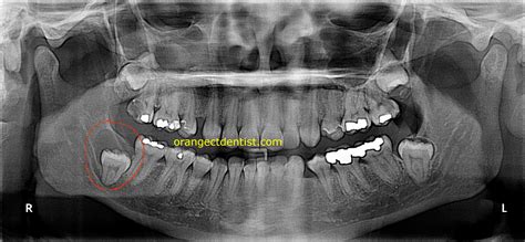 Dentigerous Cyst | Calcaterra Family Dentistry | Follicular Cyst
