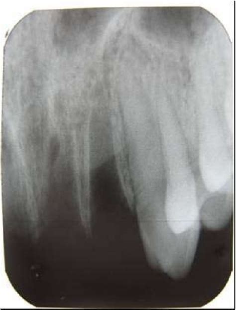 Intraoral periapical radiograph revealing empty | Download Scientific Diagram