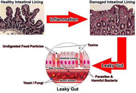 Leaky Gut Syndrome - Causes , Symptoms And Treatment