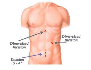 Laparoscopic Colon Resection Surgery | Dr. Benjamin Leong, MD