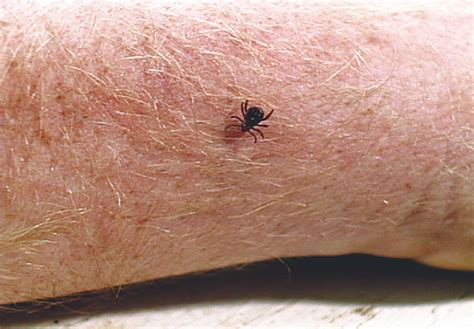 Tick & Tick Bite Identification | Tick Control & Prevention | Orkin